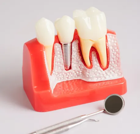 Dental Implants Icon